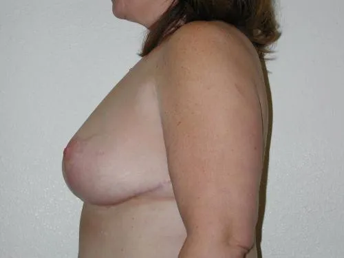 Breast Reduction patient 3, after
