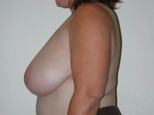 Breast Reduction patient 3, before