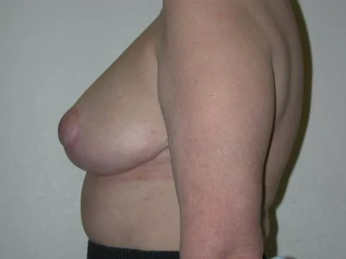 Breast Reduction patient 4, after