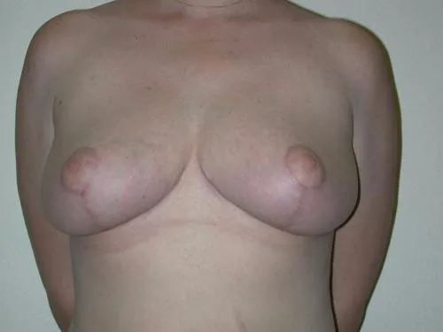 Breast Reduction patient 5, after