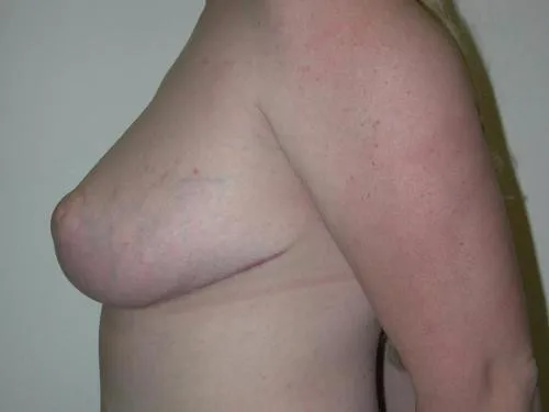 Breast Reduction patient 5, after