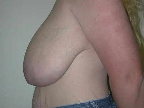 Breast Reduction patient 5, before
