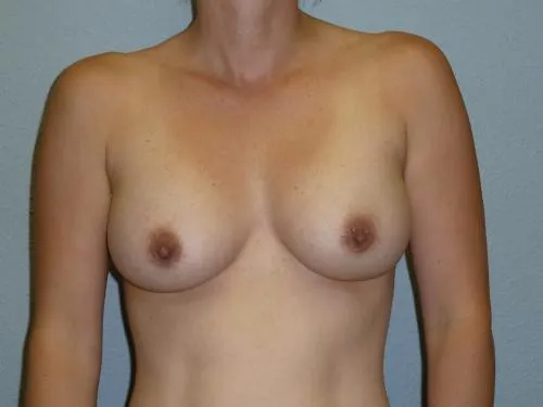 Breast Augmentation patient 26, after