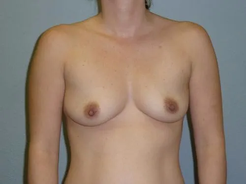 Breast Augmentation patient 26, before