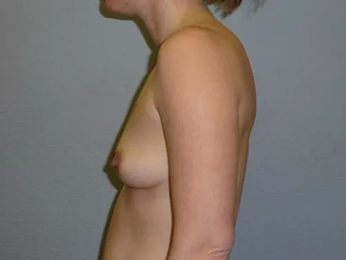 Breast Augmentation patient 26, before