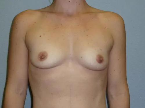 Breast Augmentation patient 12, before