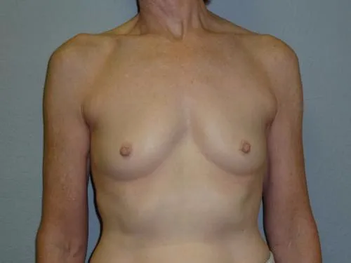 Breast Augmentation patient 8, before