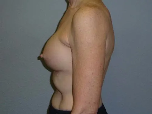 Breast Augmentation patient 8, after