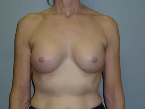 Breast Augmentation patient 8, after
