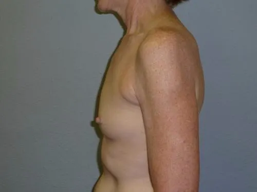 Breast Augmentation patient 8, before