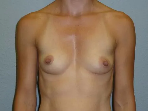 Breast Augmentation patient 24, before