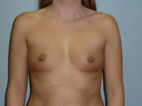 Breast Augmentation patient 22, before