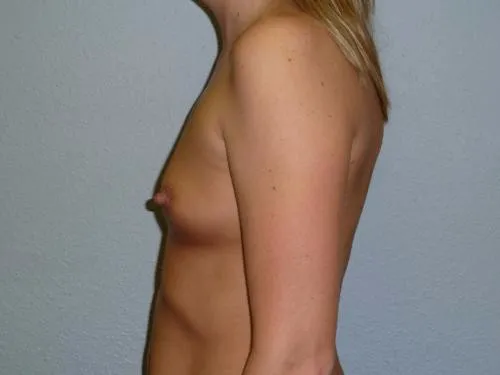 Breast Augmentation patient 22, before