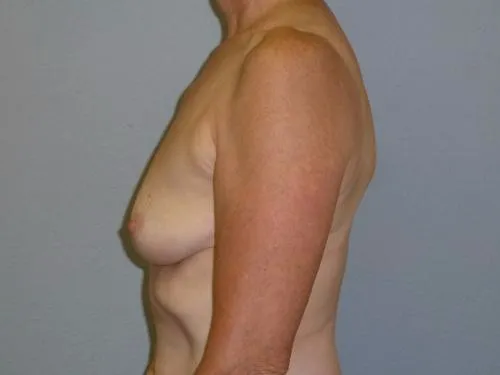 Breast Augmentation patient 23, before