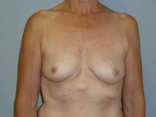 Breast Augmentation patient 23, before