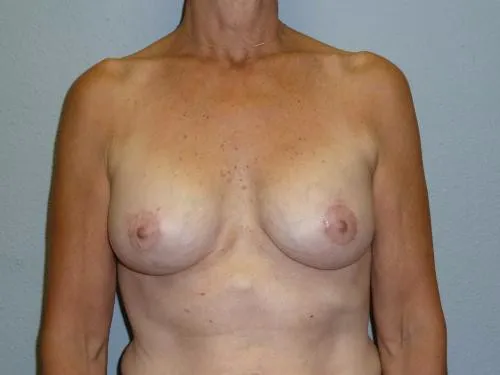 Breast Augmentation patient 23, after