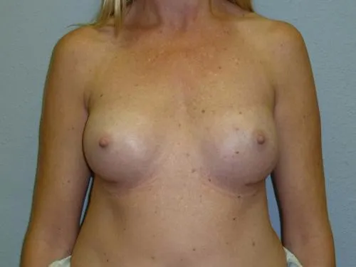 Breast Augmentation patient 21, after