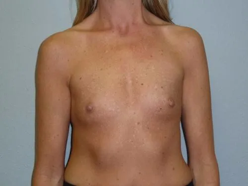 Breast Augmentation patient 21, before