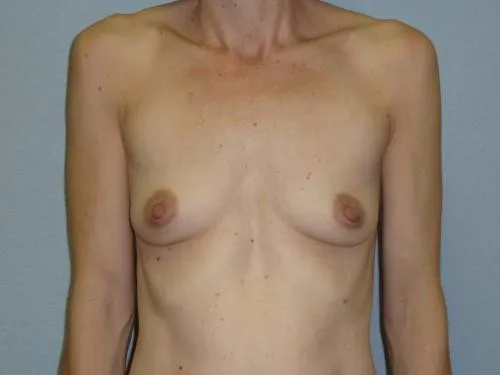 Breast Augmentation patient 19, before