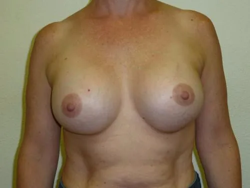 Breast Revision patient 1, before