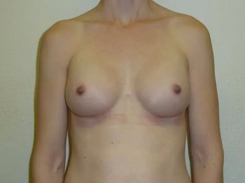 Breast Augmentation patient 16, after