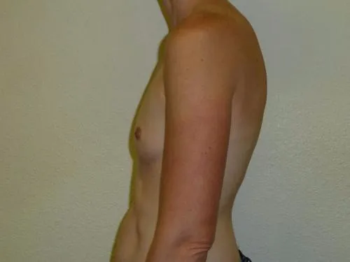Breast Augmentation patient 16, before