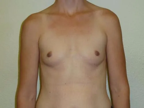 Breast Augmentation patient 16, before