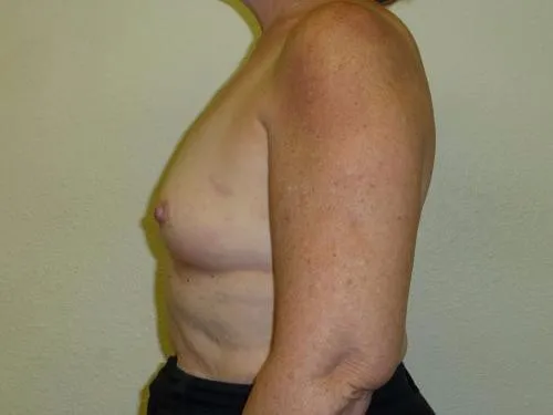 Breast Augmentation patient 11, before