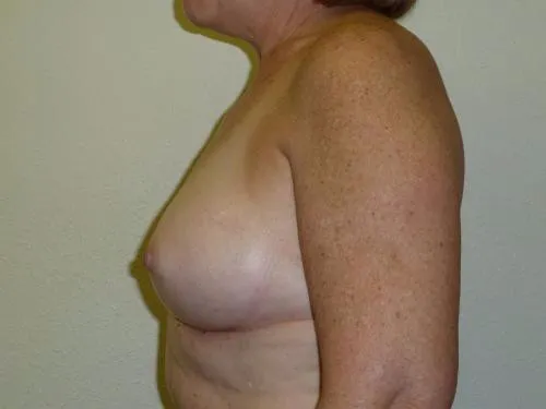 Breast Augmentation patient 11, after