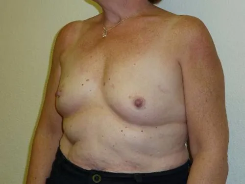 Breast Augmentation patient 11, before