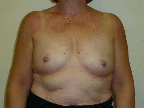 Breast Augmentation patient 11, before