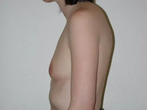 Breast Augmentation patient 10, before