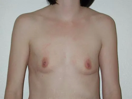 Breast Augmentation patient 10, before