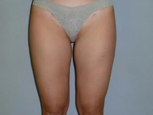 Liposuction patient 1, before