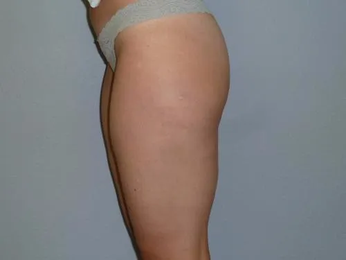 Liposuction patient 1, before