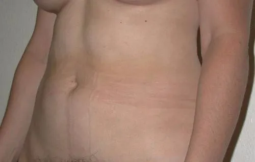 Tummy Tuck patient 4, after