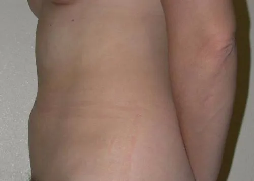 Tummy Tuck patient 4, after