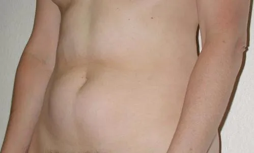 Tummy Tuck patient 4, before