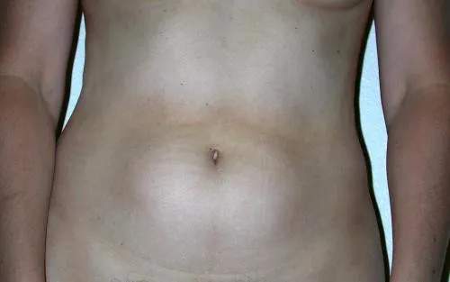 Tummy Tuck patient 4, before