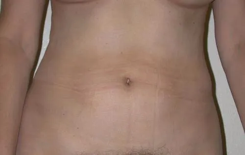 Tummy Tuck patient 4, after