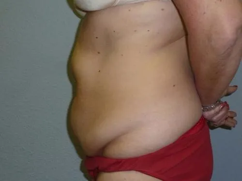 Tummy Tuck patient 5, before