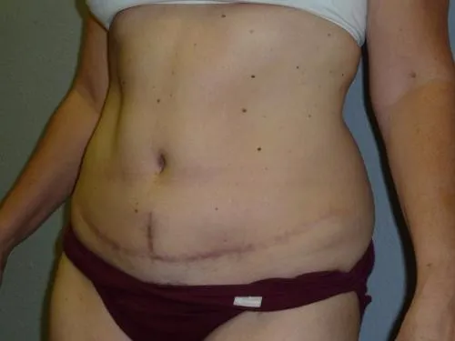 Tummy Tuck patient 5, after
