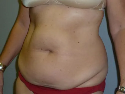 Tummy Tuck patient 5, before