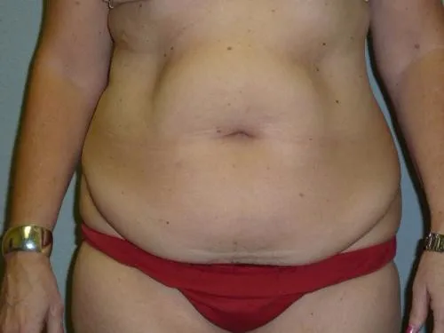 Tummy Tuck patient 5, before