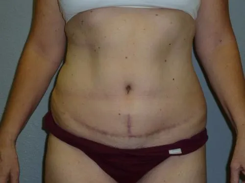 Tummy Tuck patient 5, after