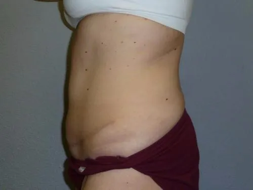 Tummy Tuck patient 5, after