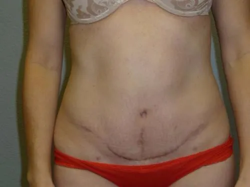 Tummy Tuck patient 6, after