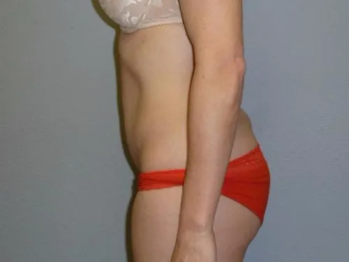 Tummy Tuck patient 6, after