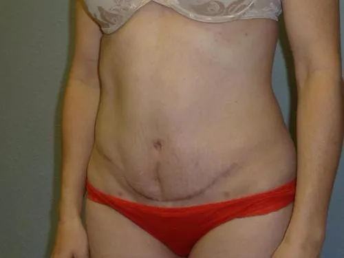 Tummy Tuck patient 6, after