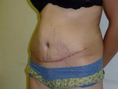 Tummy Tuck patient 3, after